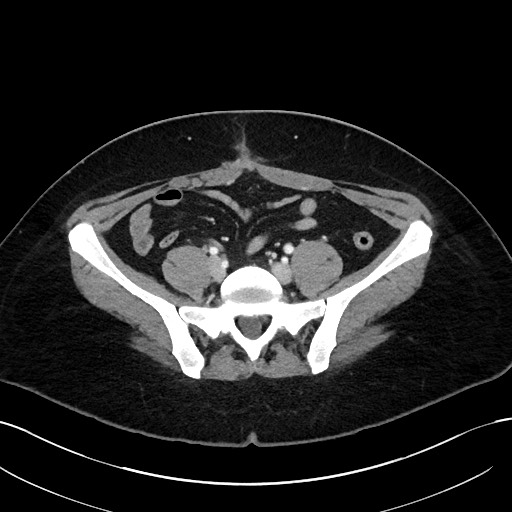 File:Choledocholithiasis after recent cholecystectomy (Radiopaedia 60929-68737 Axial 24).jpg