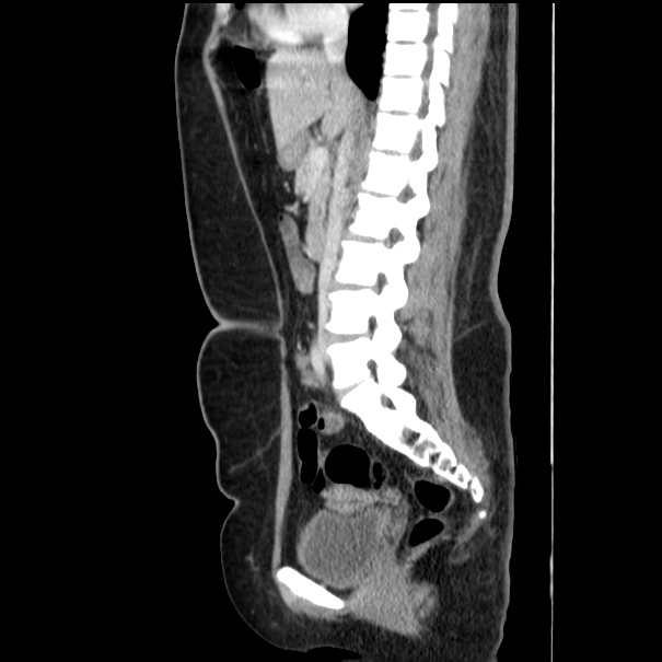 Choledocholithiasis on CT and MRI (Radiopaedia 24825-25087 D 31).jpg