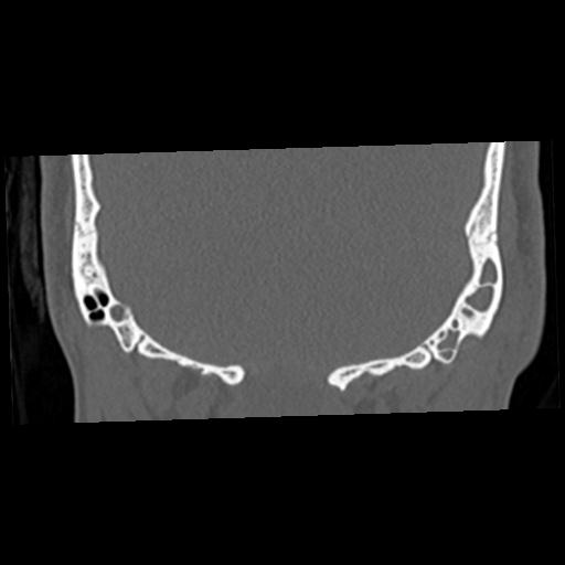 Cholesteatoma (Radiopaedia 84960-100474 Coronal bone window 62).jpg