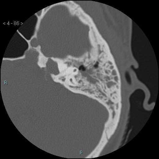 File:Cholesterol granuloma of the petrous apex (Radiopaedia 64358-73141 Axial bone window 41).jpg