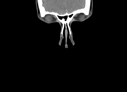Chondroblastic osteosarcoma (Radiopaedia 67363-76741 D 5).jpg