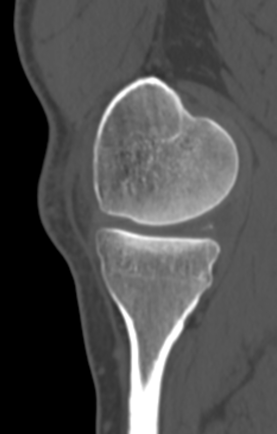 Chondrocalcinosis (Radiopaedia 82862-97173 Sagittal bone window 16).jpg