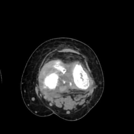 Chondrosarcoma - femur (Radiopaedia 64187-72954 Axial non-contrast 55).jpg