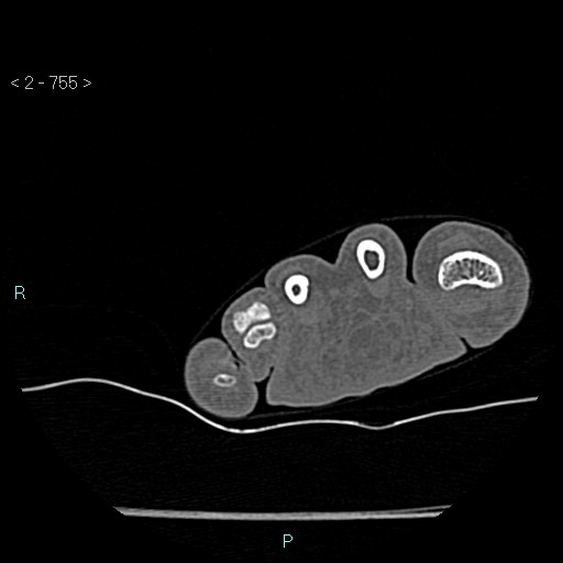 Chondrosarcoma - phalanx (Radiopaedia 69047-78812 Axial bone window 9).jpg