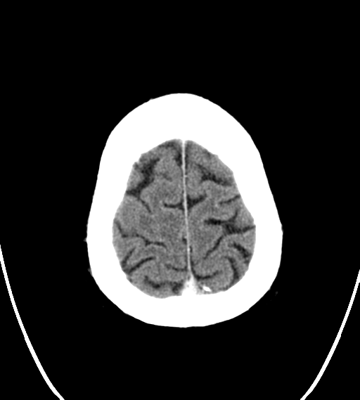 File:Chondrosarcoma of skull base- grade II (Radiopaedia 40948-43653 Axial Contrast 27).png