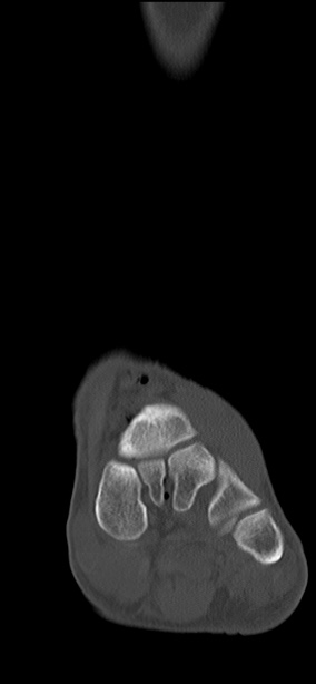 Chopart fracture (Radiopaedia 35347-36851 Coronal bone window 49).jpg