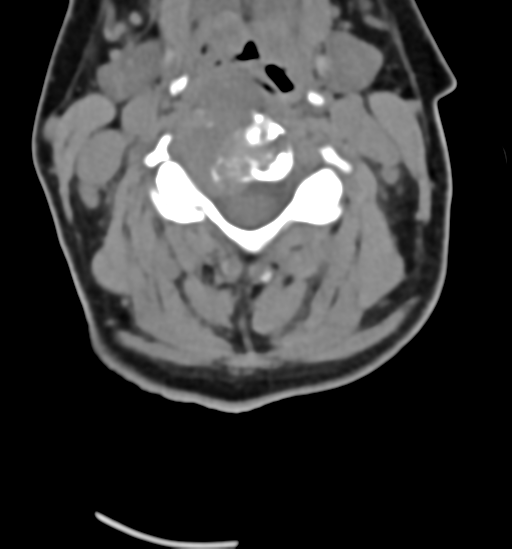 File:Chordoma (C4 vertebra) (Radiopaedia 47561-52188 Axial non-contrast 25).png