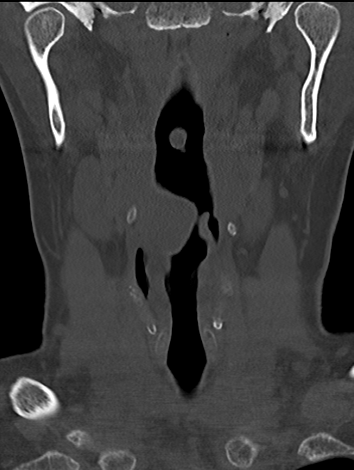 Chordoma (C4 vertebra) (Radiopaedia 47561-52188 Coronal bone window 5).png