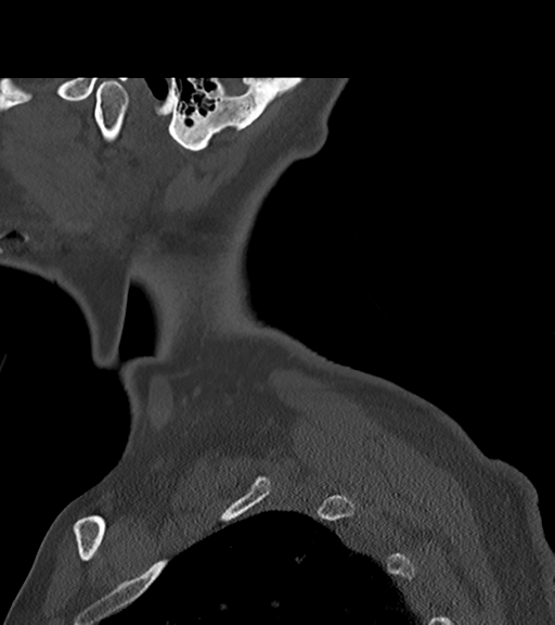 File:Chordoma (C4 vertebra) (Radiopaedia 47561-52188 Sagittal bone window 3).png