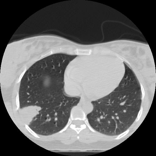File:Choriocarcinoma of ovary with cerebral and pulmonary metastases (Radiopaedia 25983-26119 Axial lung window 12).jpg
