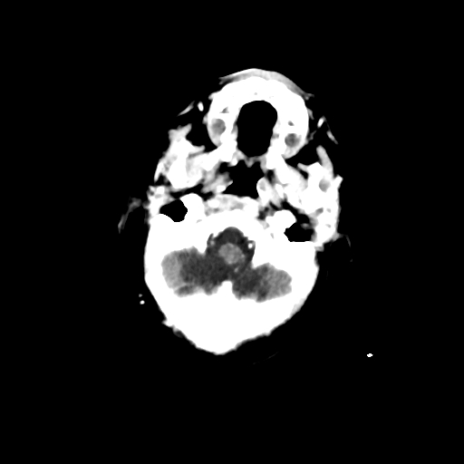 Choroid plexus papilloma (Radiopaedia 63946-72698 Axial with contrast 4).jpg