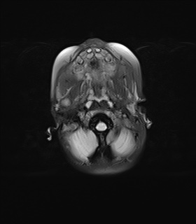 File:Choroid plexus papilloma (Radiopaedia 84612-100019 Axial FLAIR 4).jpg