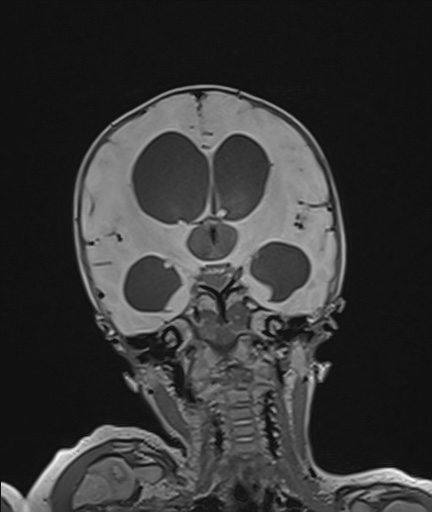 File:Choroid plexus papilloma (Radiopaedia 84612-100019 Coronal FLAIR 63).jpg