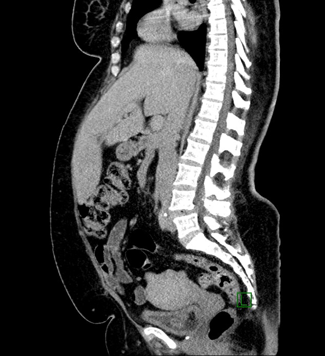 Chromophobe renal cell carcinoma (Radiopaedia 84239-99519 G 67).jpg