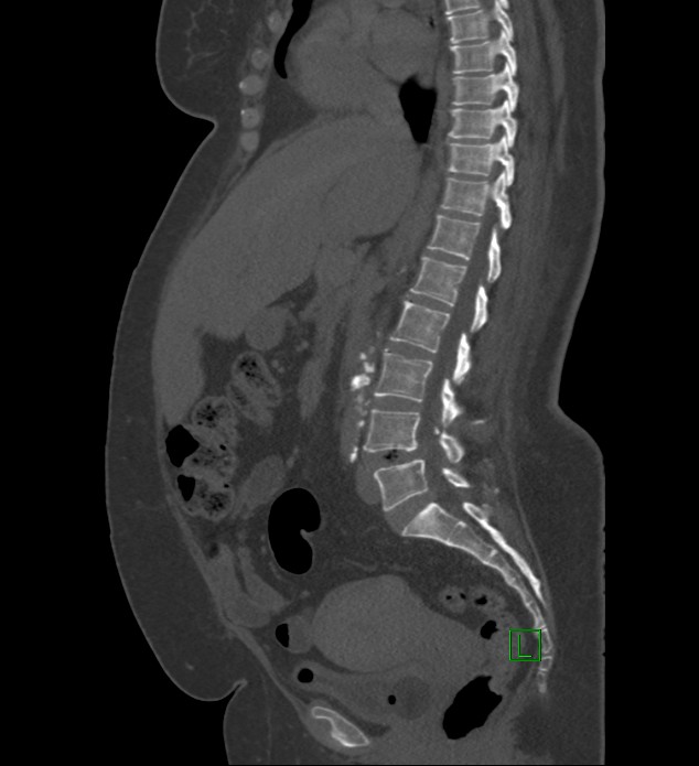 Chromophobe renal cell carcinoma (Radiopaedia 84239-99519 Sagittal bone window 57).jpg