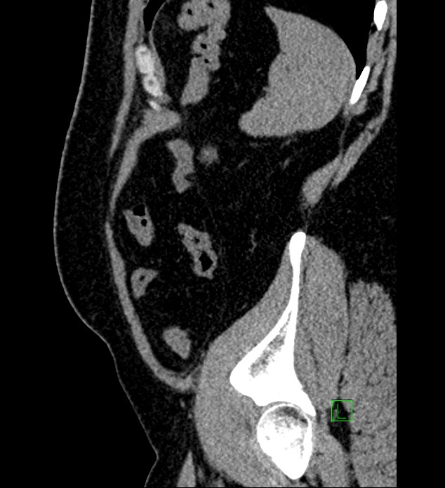 Chromophobe renal cell carcinoma (Radiopaedia 84286-99573 C 24).jpg