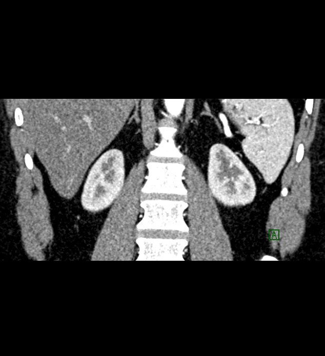Chromophobe renal cell carcinoma (Radiopaedia 84286-99573 E 63).jpg
