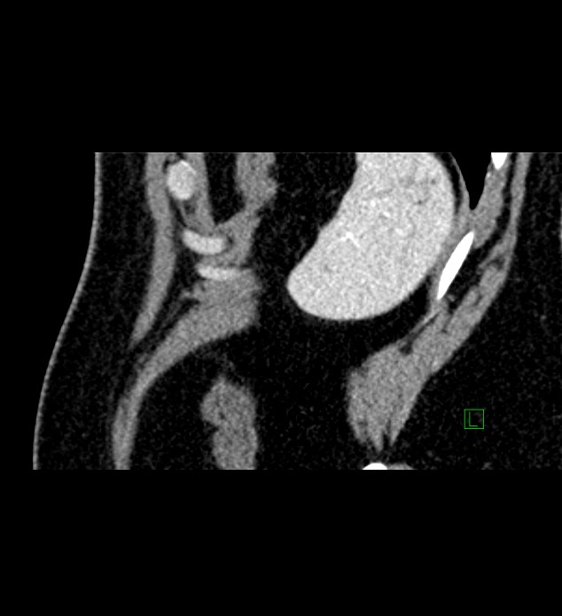 Chromophobe renal cell carcinoma (Radiopaedia 84286-99573 F 12).jpg