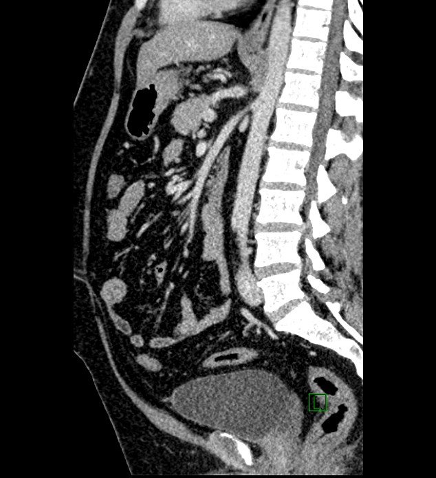 Chromophobe renal cell carcinoma (Radiopaedia 84286-99573 I 86).jpg