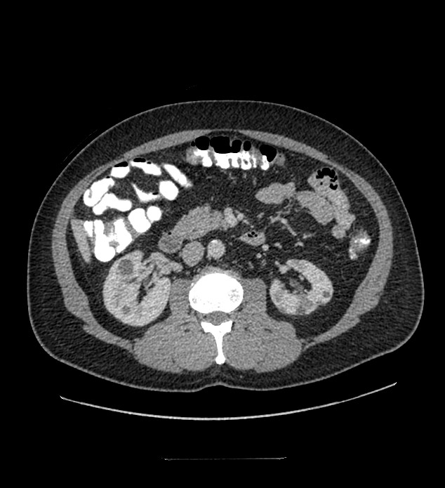 Chromophobe renal cell carcinoma (Radiopaedia 84337-99644 C 58).jpg