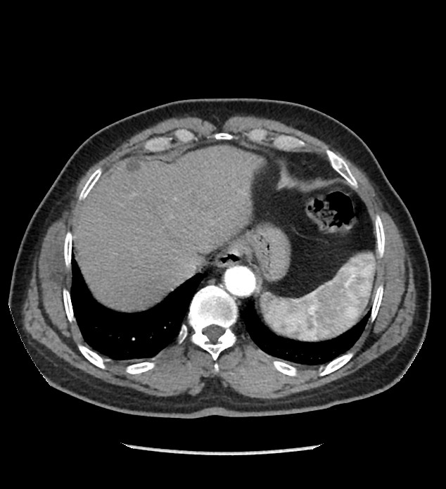 Chromophobe renal cell carcinoma (Radiopaedia 86879-103083 B 23).jpg