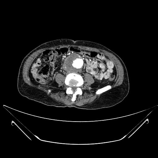 File:Chronic contained rupture of abdominal aortic aneurysm with extensive erosion of the vertebral bodies (Radiopaedia 55450-61901 A 39).jpg