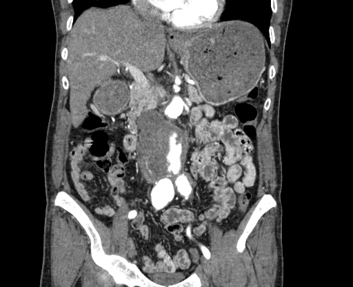 File:Chronic contained rupture of abdominal aortic aneurysm with extensive erosion of the vertebral bodies (Radiopaedia 55450-61901 D 28).jpg