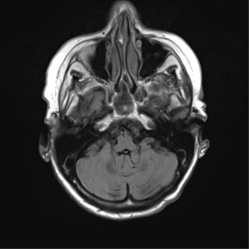 File:Chronic hypertensive encephalopathy (Radiopaedia 72844-83495 Axial FLAIR 5).png