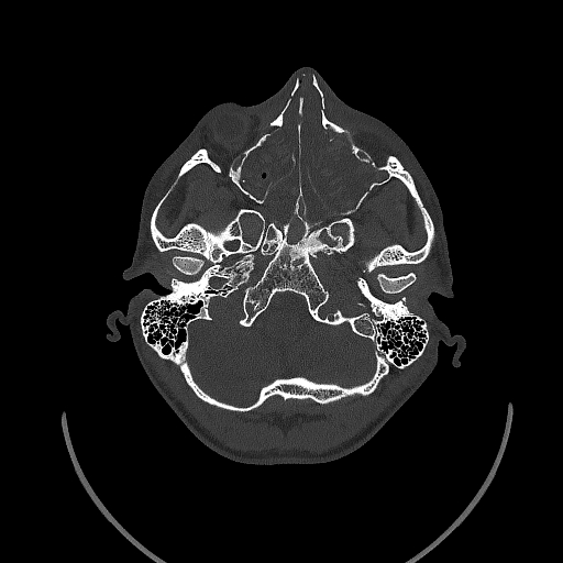 Chronic invasive fungal sinusitis (Radiopaedia 50342-55710 Axial bone window 48).jpg