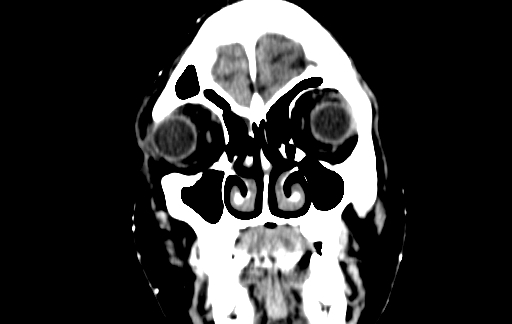 Chronic invasive fungal sinusitis (Radiopaedia 91563-109286 D 4).jpg