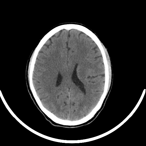 Chronic invasive fungal sinusitis with intraorbital and intracranial extension (Radiopaedia 56387-63046 Axial non-contrast 235).jpg
