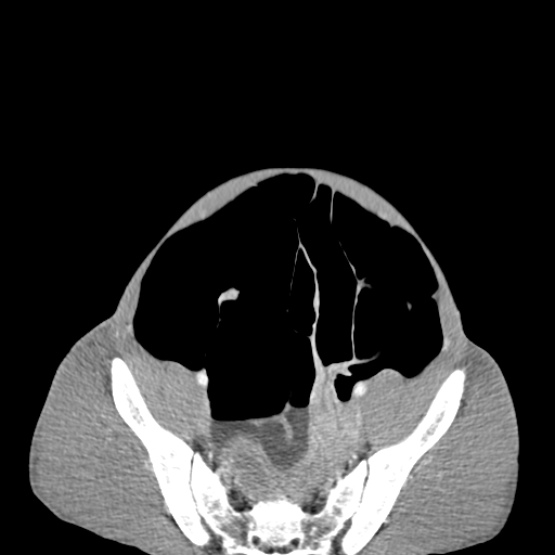 Chronic large bowel pseudo-obstruction (Radiopaedia 43181-46492 A 137).jpg