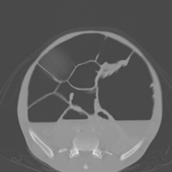 File:Chronic large bowel pseudo-obstruction (Radiopaedia 43181-46492 Axial bone window 118).jpg
