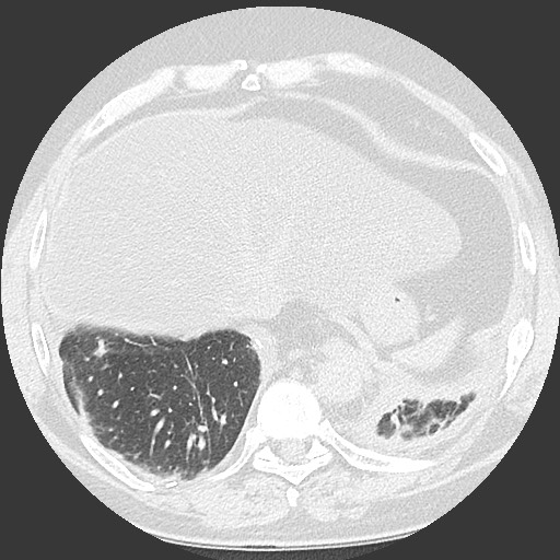 Chronic lung allograft dysfunction - restrictive form (Radiopaedia 60595-68316 Axial lung window 58).jpg
