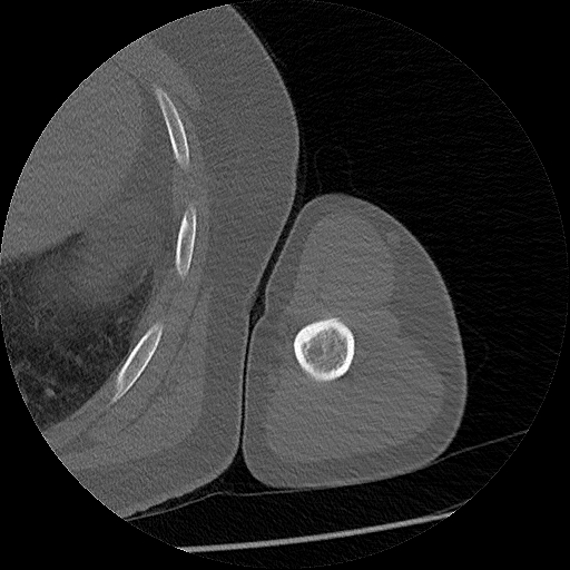 Chronic osteomyelitis (Radiopaedia 67597-76998 Axial bone window 31).jpg