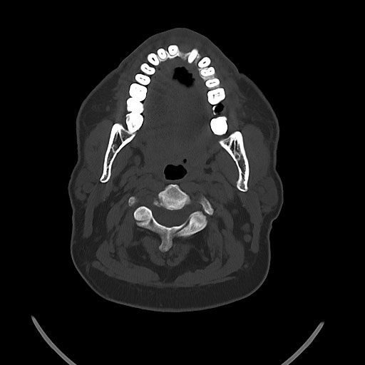 Chronic osteomyelitis - calvarial (severe) (Radiopaedia 69668-79616 Axial bone window 13).jpg