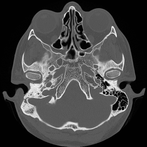 File:Chronic otomastoiditis (Radiopaedia 27138-27309 Axial bone window 20).jpg
