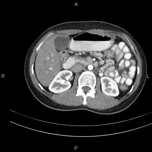 Chronic pancreatitis (Radiopaedia 64576-73450 B 63).jpg