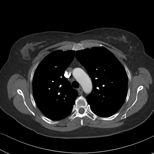 Chronic pulmonary embolus (Radiopaedia 39129-41341 Axial C+ CTPA 34).png