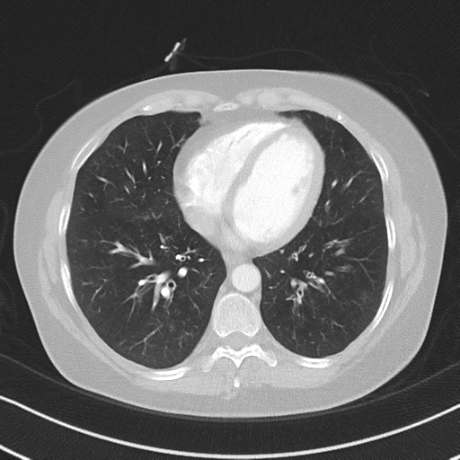 Chronic pulmonary embolus (Radiopaedia 39129-41341 Axial lung window 42).png