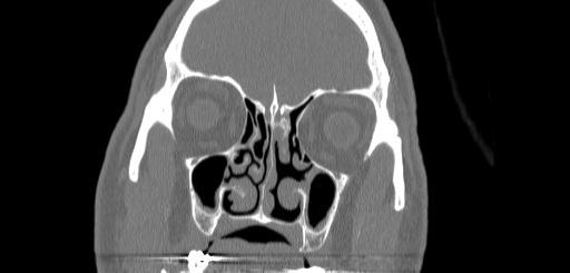 Chronic sphenoidal sinusitis (Radiopaedia 62030-70122 Coronal bone window 57).jpg