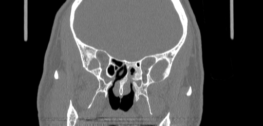 Chronic sphenoidal sinusitis (Radiopaedia 62030-70122 Coronal bone window 98).jpg