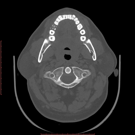 Chronic submandibular sialolithiasis (Radiopaedia 69817-79814 Axial bone window 35).jpg