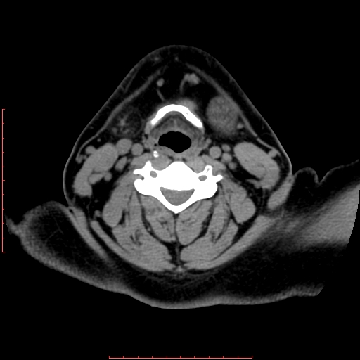 Chronic submandibular sialolithiasis (Radiopaedia 69817-79814 Axial non-contrast 149).jpg