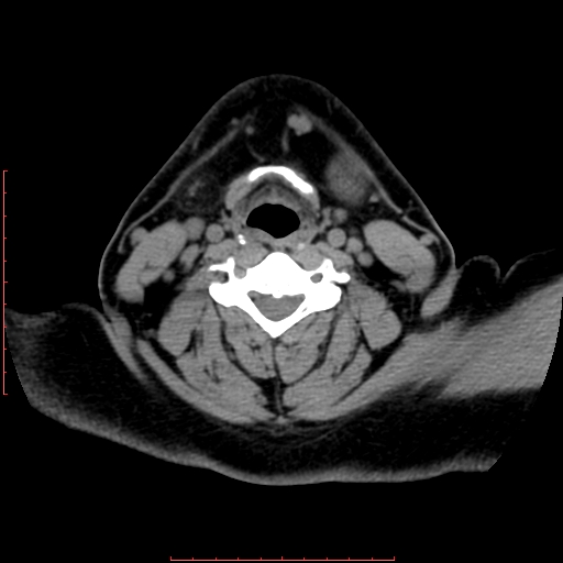 Chronic submandibular sialolithiasis (Radiopaedia 69817-79814 Axial non-contrast 152).jpg