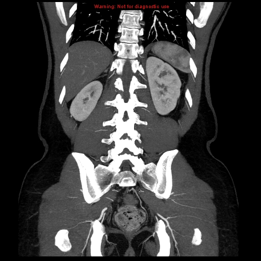 File:Circumaortic left renal vein (Radiopaedia 9069-9792 B 34).jpg