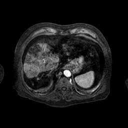 Cirrhosis and hepatocellular carcinoma in the setting of hemochromatosis (Radiopaedia 75394-86594 Axial T1 C+ fat sat 147).jpg