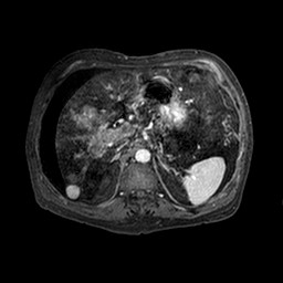 File:Cirrhosis and hepatocellular carcinoma in the setting of hemochromatosis (Radiopaedia 75394-86594 Axial T1 C+ fat sat 217).jpg