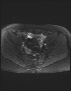 Class II Mullerian duct anomaly- unicornuate uterus with rudimentary horn and non-communicating cavity (Radiopaedia 39441-41755 Axial DWI 12).jpg