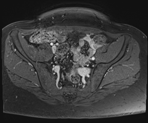 File:Class II Mullerian duct anomaly- unicornuate uterus with rudimentary horn and non-communicating cavity (Radiopaedia 39441-41755 Axial T1 fat sat 29).jpg